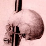 1-phineas-gage-skull